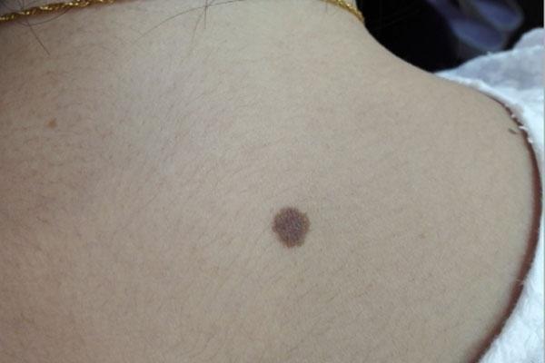 为什么大多数人的后颈上都有一颗痣？这是好事还是坏事？